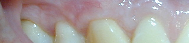 Deckung freiliegender Zahnhals mit Bindegewebstransplantat